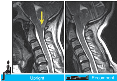 Case #2: Chiari Malformation Visualization When Upright